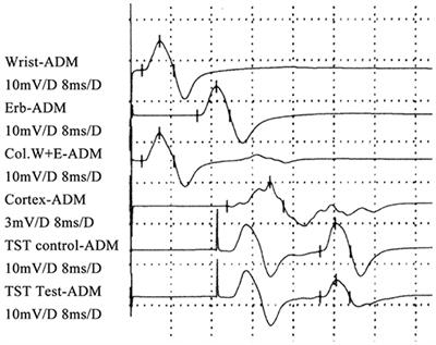 Upper Motor Neuron Signs in the Cervical Region of Patients With Flail Arm Syndrome